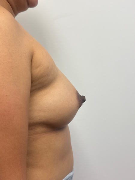 After Image: Breast Augmentation - back
