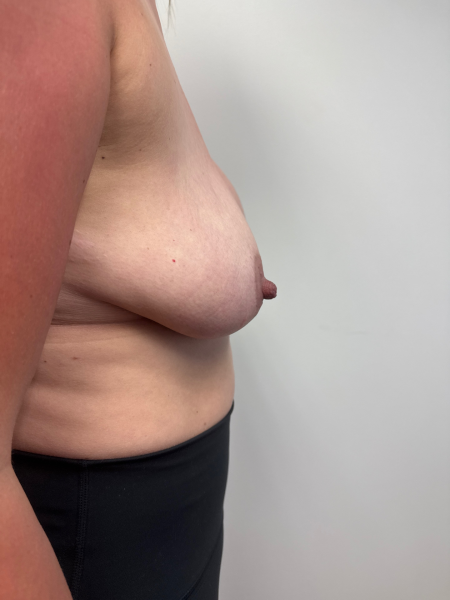 Before Image: Breast Reduction - right-side