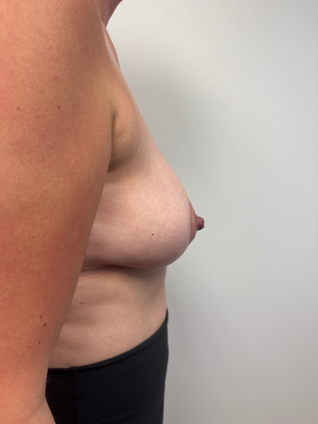 After Image: Breast Reduction - right-side