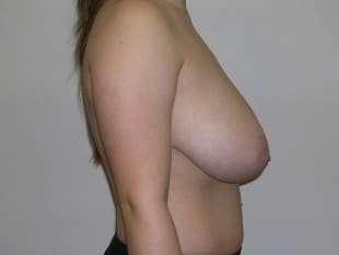 Before Image: Breast Reduction - front