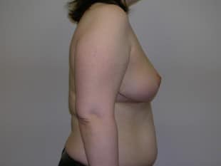 Breast Reduction