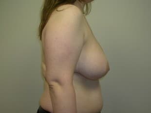 Breast Reduction