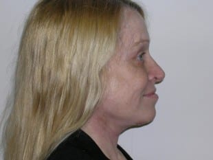 Blepharoplasty