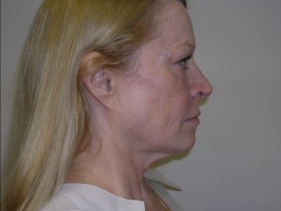 Blepharoplasty