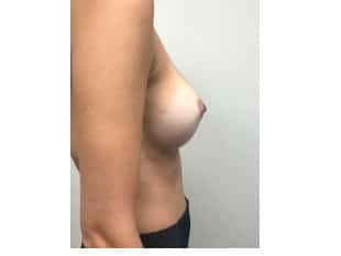 Breast Augmentation