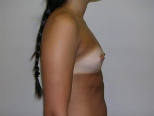 Breast Augmentation