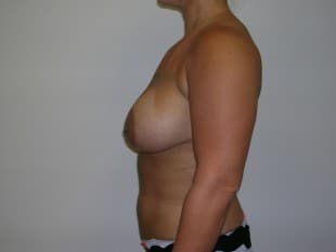 After Image: Breast Augmentation - front