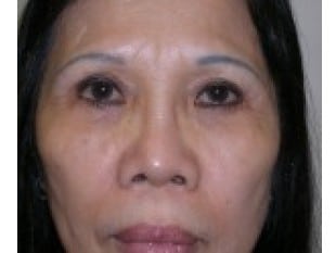Blepharoplasty