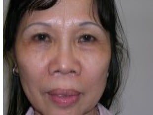 Blepharoplasty
