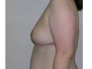 Breast Reduction