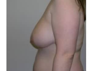 Breast Reduction