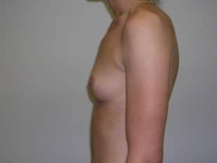 Before Image: Breast Augmentation - other