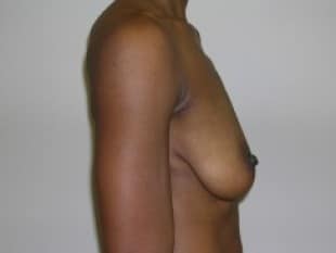 Breast Augmentation