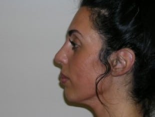 After Image: Rhinoplasty - other