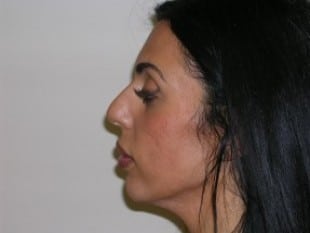 Before Image: Rhinoplasty - other