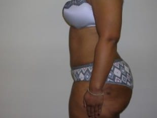 After Image: Abdominoplasty - other