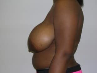 Breast Reduction