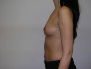 Breast Augmentation