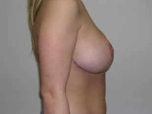 Breast Reduction