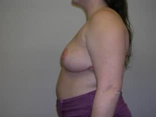 Breast Reduction