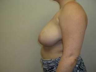 Breast Reduction