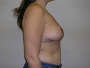 Breast Reduction