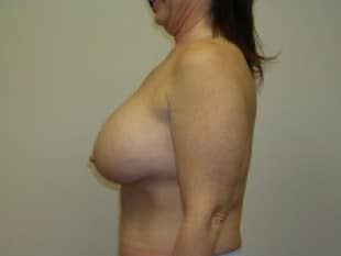 Breast Augmentation