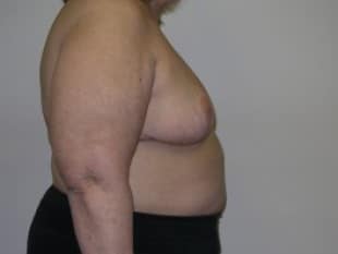 Breast Reduction