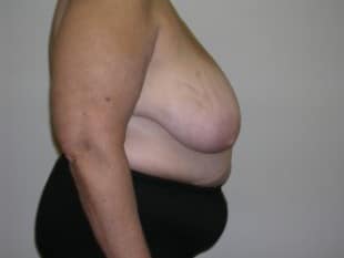 Breast Reduction