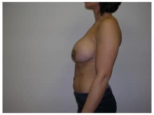 Breast Augmentation