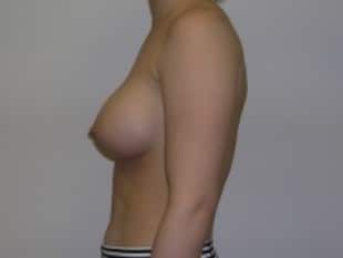 Breast Augmentation