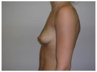 Breast Augmentation
