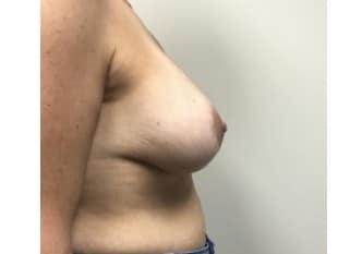 Breast Lift, Bergen County, Paramus