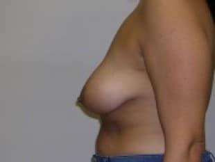 Breast Lift, Bergen County, Paramus