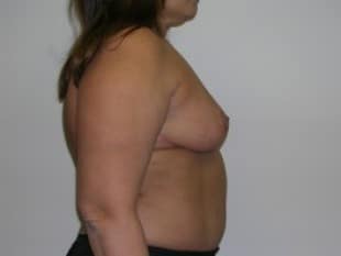 Breast Lift