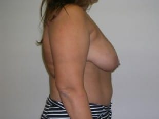 Breast Lift