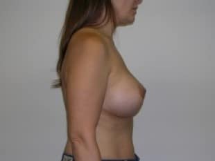 Breast Lift
