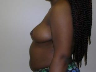Breast Reduction