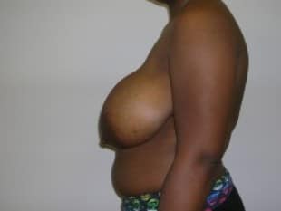 Breast Reduction