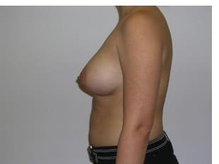 Breast Augmentation