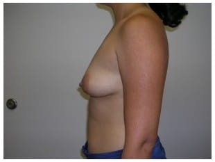 Breast Augmentation