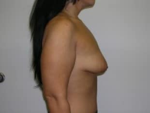 Breast Lift
