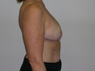 After Image: Breast Reduction - other