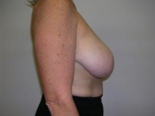 Before Image: Breast Reduction - other