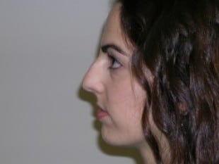 Rhinoplasty