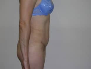 Abdominoplasty