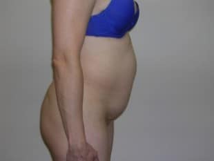 Abdominoplasty