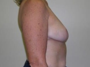 Breast Reduction