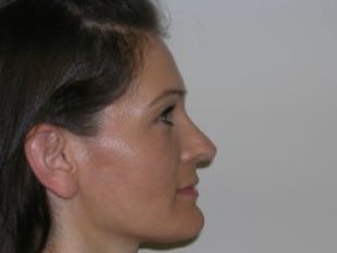 After Image: Rhinoplasty - front