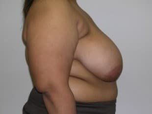 Breast Reduction